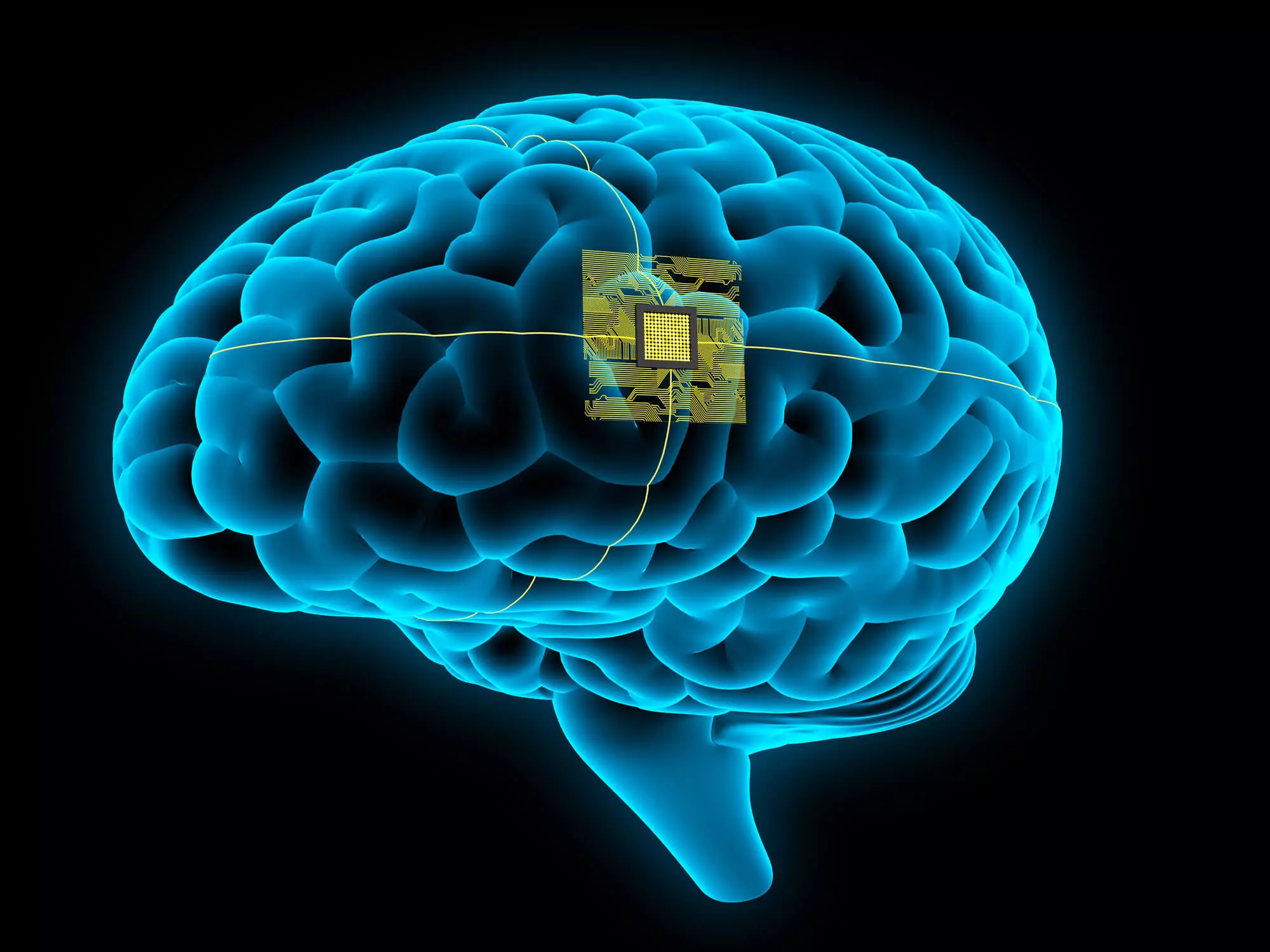 Implant cerebral Neuralink